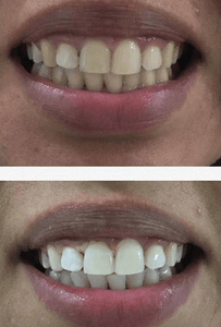 SNOW TEETH WHITENING™ – SYSTEM DO WYBIELANIA ZĘBÓW W DOMU [ZESTAW WSZYSTKO W JEDNYM]