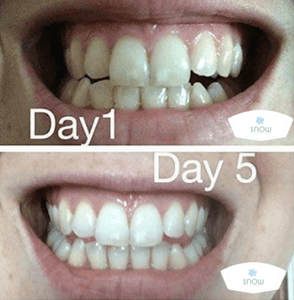 SNOW TEETH WHITENING™ – SYSTEM DO WYBIELANIA ZĘBÓW W DOMU [ZESTAW WSZYSTKO W JEDNYM]