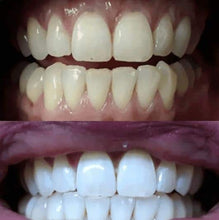 Load image into Gallery viewer, SISTEMA EM CASA SNOW TEETH WHITENING™ [‘KIT’ COMPLETO]
