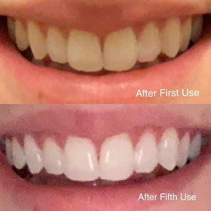 Snow Teeth Whitening™ At-Home System All-in-One Kit