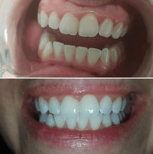 SNOW TEETH WHITENING™ – SYSTEM DO WYBIELANIA ZĘBÓW W DOMU [ZESTAW WSZYSTKO W JEDNYM]