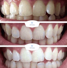 Load image into Gallery viewer, SISTEMA DE CLAREAMENTO DENTAL CASEIRO SNOW™ [KIT TUDO-EM-UM]
