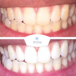 SNOW TEETH WHITENING™ – SYSTEM DO WYBIELANIA ZĘBÓW W DOMU [ZESTAW WSZYSTKO W JEDNYM]