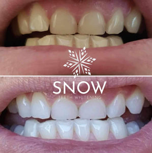 Floyd Mayweather's Snow Teeth Whitening™ At-Home System [All-in-One Kit]