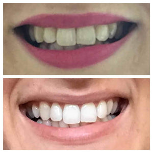 Snow® Teeth Whitening At-Home System [All-in-One Kit] - $99