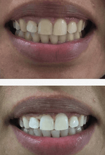 Load image into Gallery viewer, SISTEMA EM CASA SNOW TEETH WHITENING™ [‘KIT’ COMPLETO]
