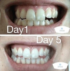 Special Offer - SNOW Teeth Whitening™ System