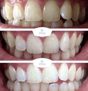 Special Offer - SNOW Teeth Whitening™ System